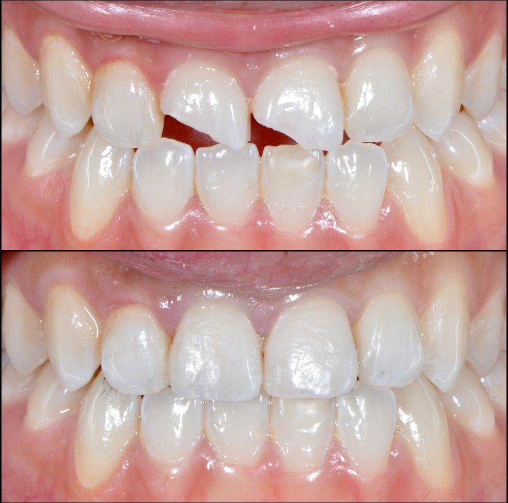 Anterior Composite Restoration
